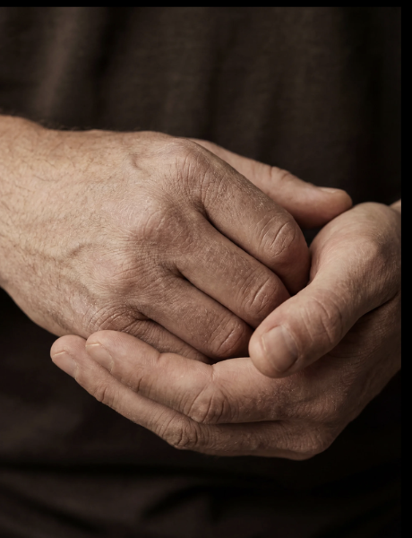 Hands before — dry, cracked, dehydrated skin